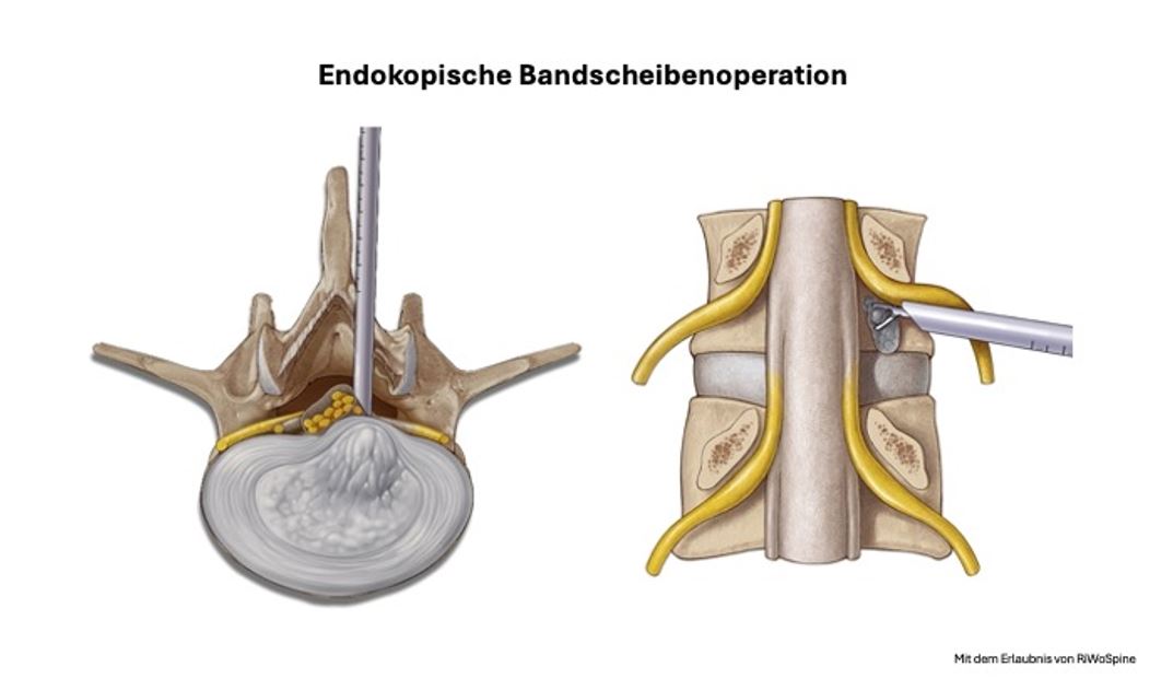 Behandlung von Bandscheibenvorfällen und Spinalkanalstenosen